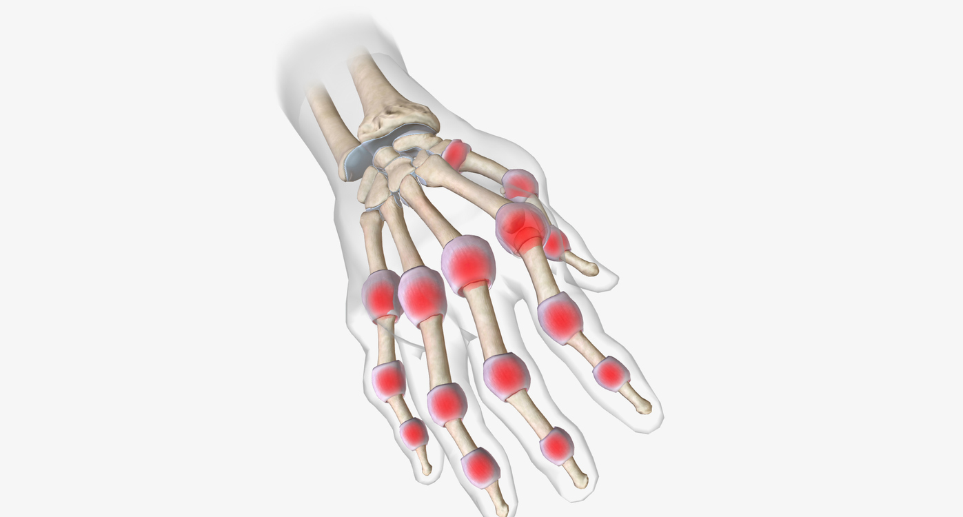 arthrose distale des doigtz